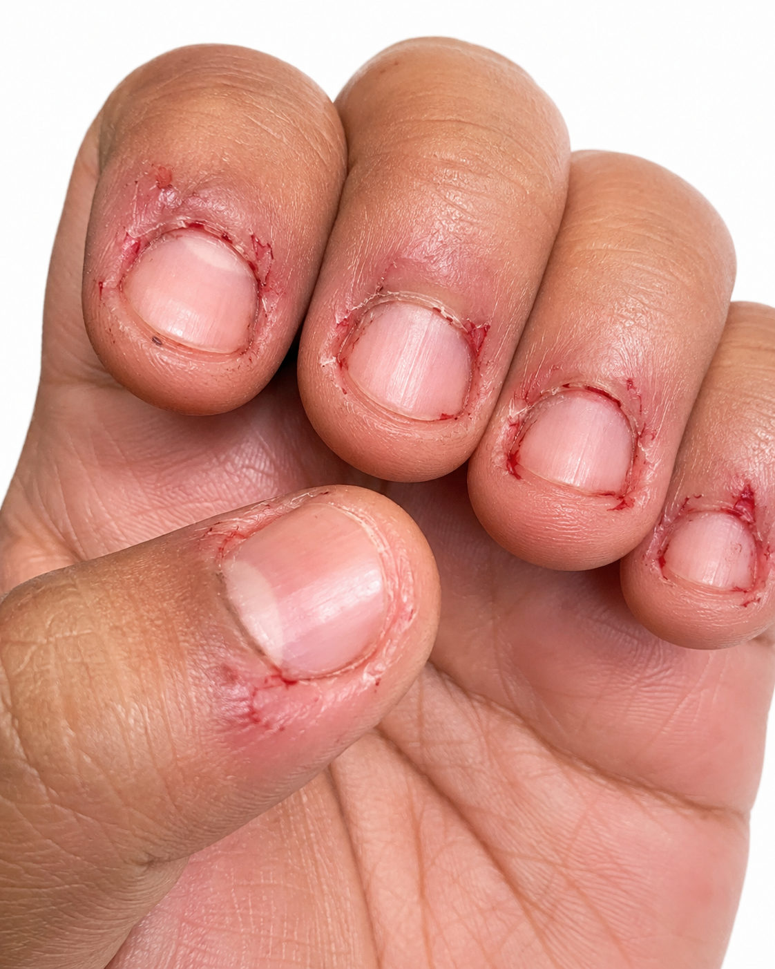 A second customer's fingers before — sore, picked skin around the nails and cuticles